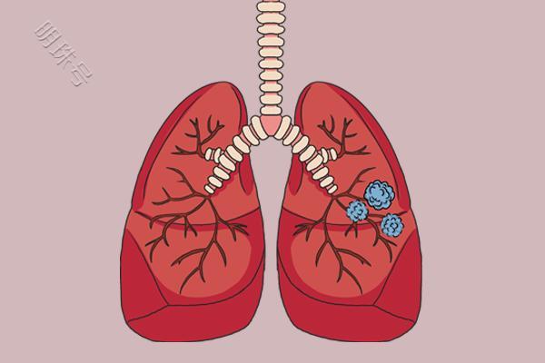 查出2公分内肺结节，是肺叶切除还是肺段切除？了解下