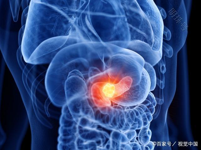 “癌王”胰腺癌很会伪装，身体出现4个“信号”，尽早就医