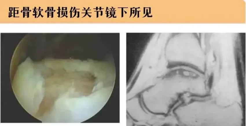 踝关节扭伤后疼痛3年，深受其苦！最终医生建议检查核磁发现病因