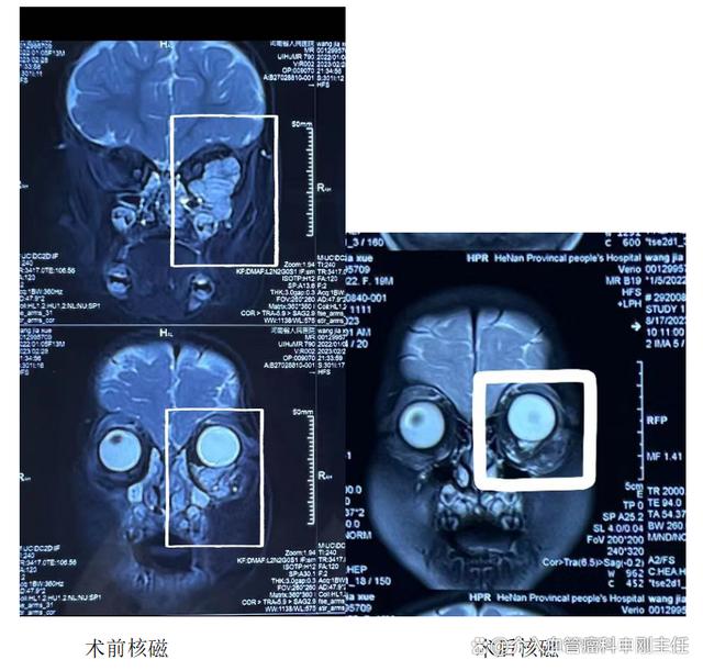 眶内静脉畸形介入微创治疗病例