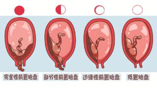 什么是胎盘前置？ 它对妊娠和分娩有何影响？