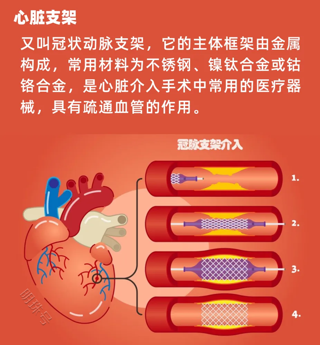 放完支架，怎么预防心脏再出问题，不妨参考下