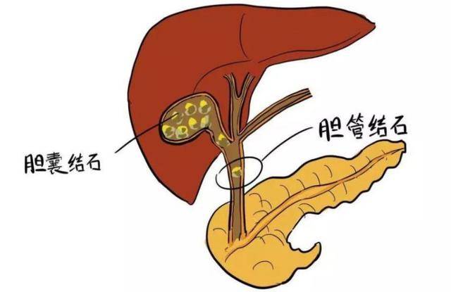 人没了胆囊，身体会有哪些变化