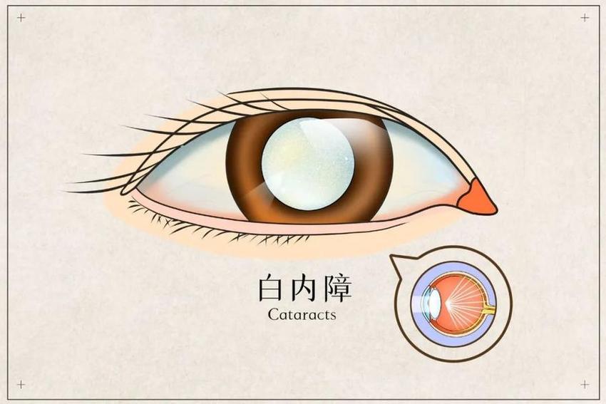 白内障成熟才能做手术？错啦！