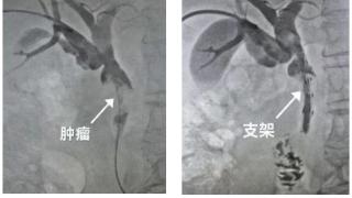 省内首例！山东大学齐鲁医院普通外科胆道肿瘤治疗团队实施放射性粒子胆道支架置入术治疗胆管癌