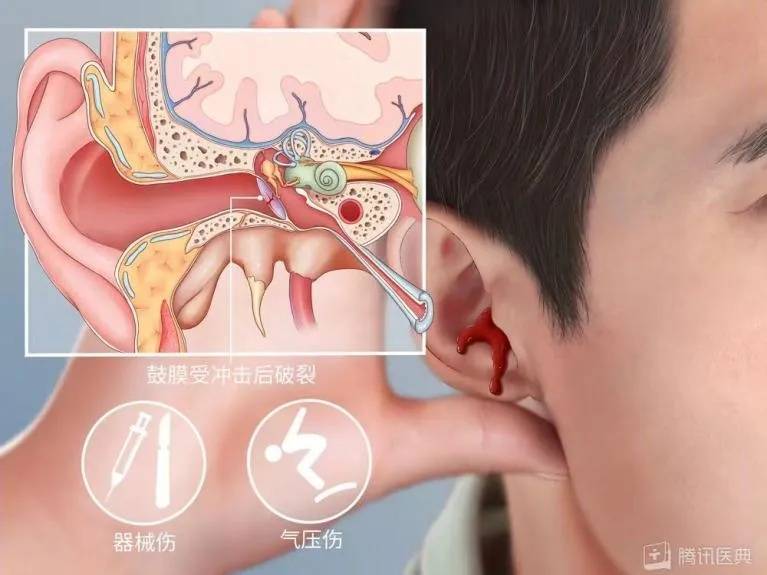 颅内感染、脑脊液从耳朵流出！一岁半娃鼓膜穿孔竟是因为……