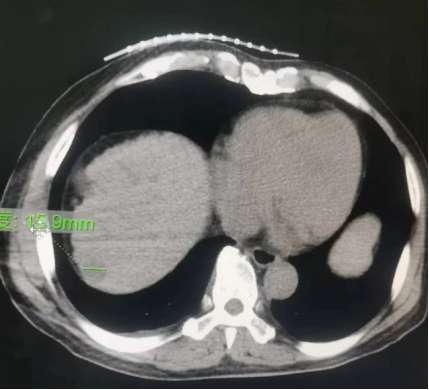 新突破！巨野县中医医院外三科成功实施首例肝肿瘤射频消融术