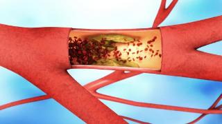心血管病同样预防血栓，为何有人吃阿司匹林，而有人却吃华法林？