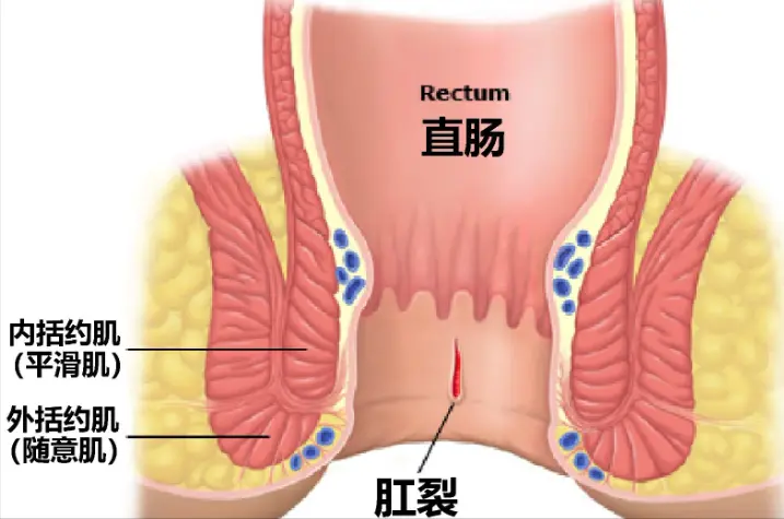 肛裂是一种怎样的体验？5个行为是肛裂根源，千万别乱来